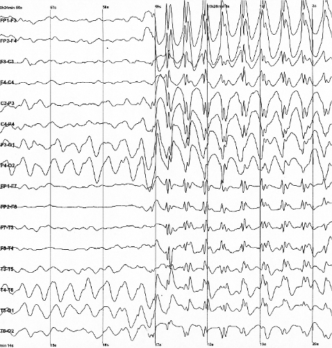 **Figure: EEG Data Plot Example**. Electro-Encephalo-Graphy (EEG) Spike data Plot Example. ---Image Credit: Wikimedia.