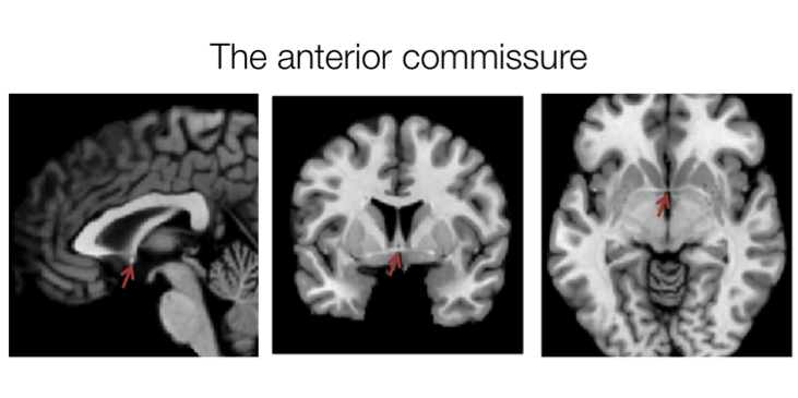 Figure 7.4. The location of the anterior commissure.