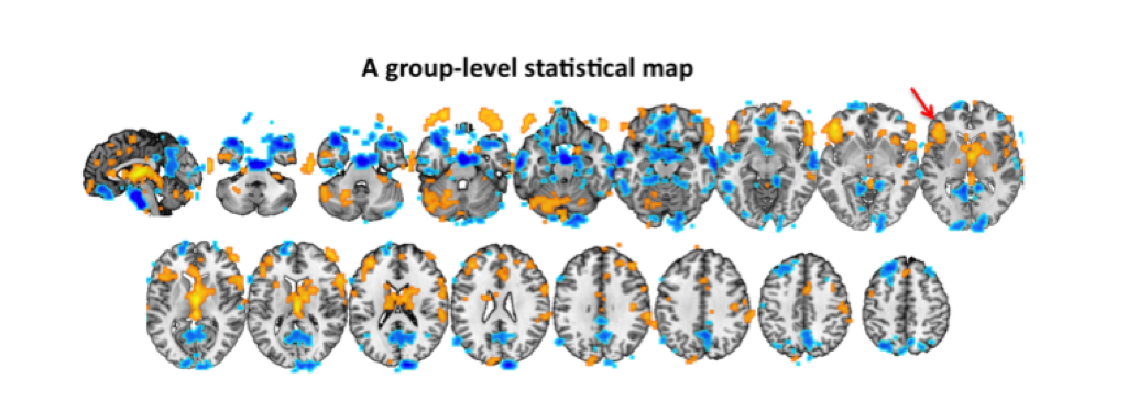 Figure 4.1. An example of a statistical map. These types of maps show brain areas where researchers have deemed some effect of interest statistically significant.